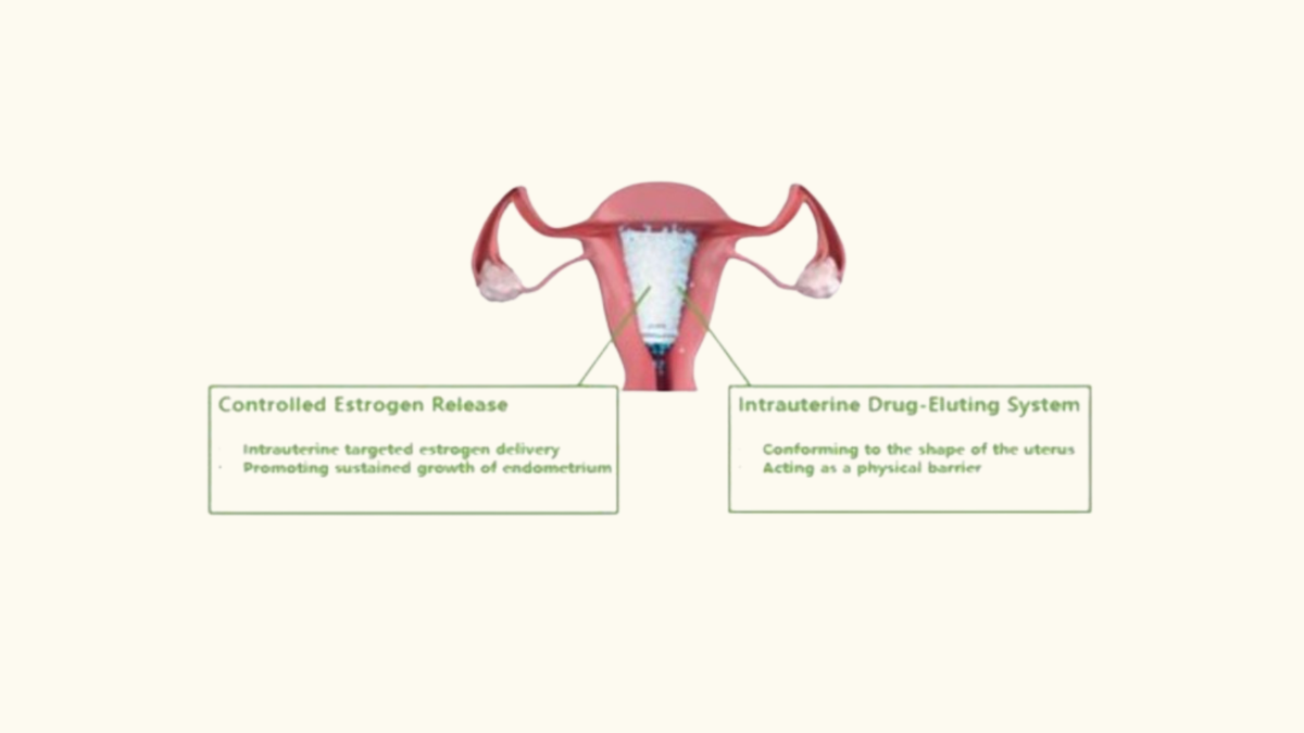 Corina Intrauterine Drug-Eluting System receives approval in China for the treatment of intrauterine adhesions