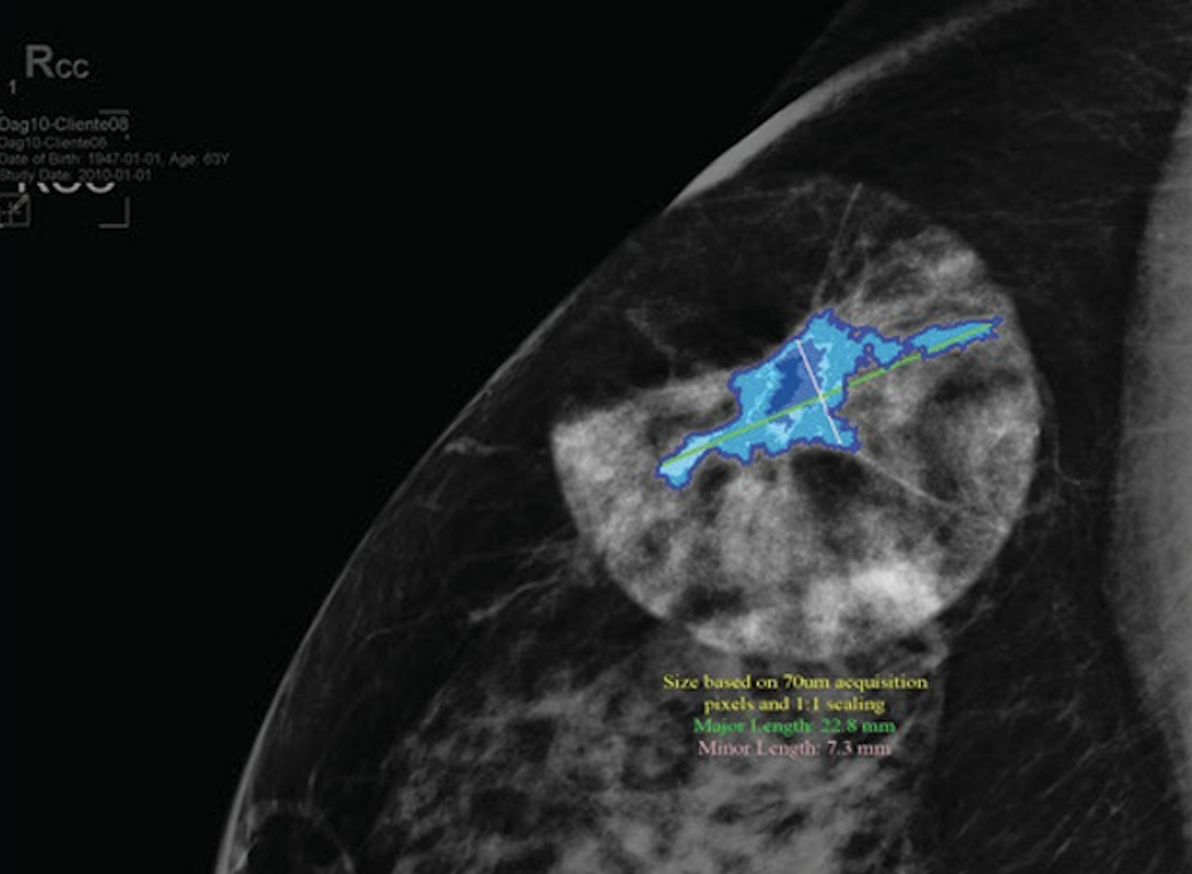 Major US Hospitals Adopt DeepLook Medical’s AI Platform for Breast Cancer Detection
